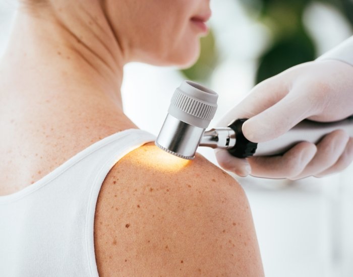Clinician examining a mole on a woman’s shoulder with a dermatoscope Clinician examining a mole on a woman’s shoulder with a dermatoscope