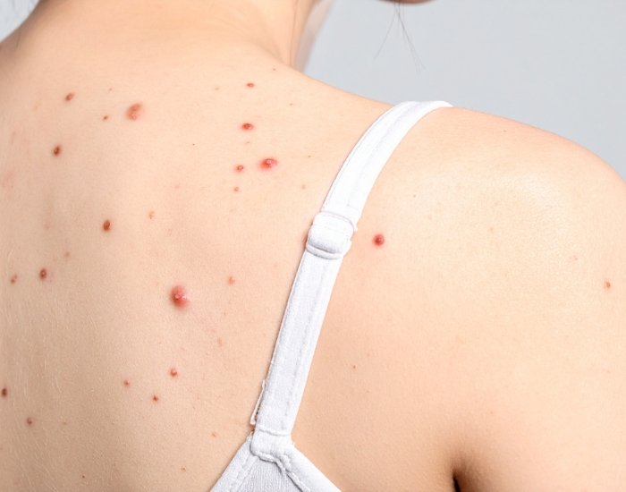 Malignant Melanoma Richmond: Symptoms, Risk Factors & Treatment