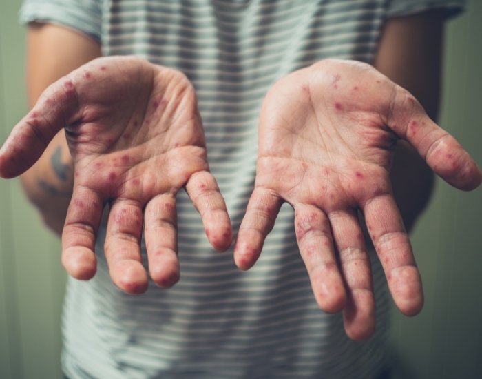 Hands, Foot, and Mouth Disease Houston: Symptoms, Causes & Care