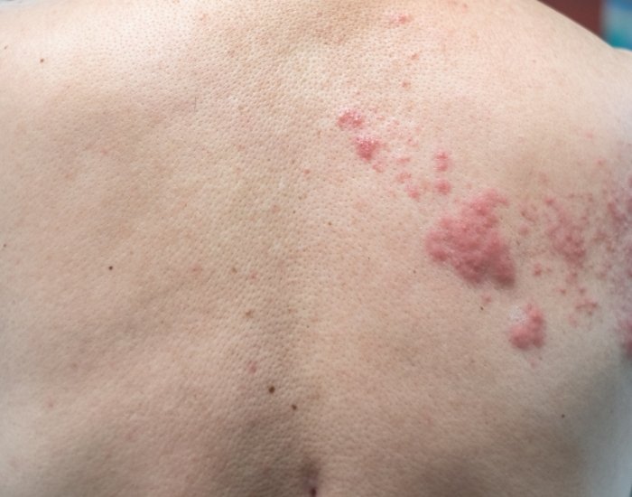 Is the Virus Shingles Contagious can you catch shingles from someone with shingles rash