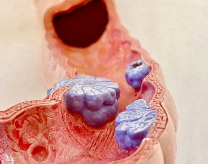 early colon cancer symptoms in men and women explained clearly
