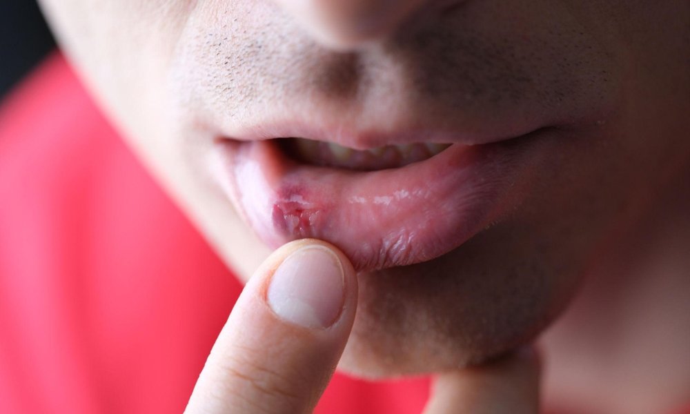 Common triggers for oral herpes including stress illness sunlight and fatigue