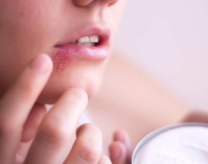 oral herpes symptoms