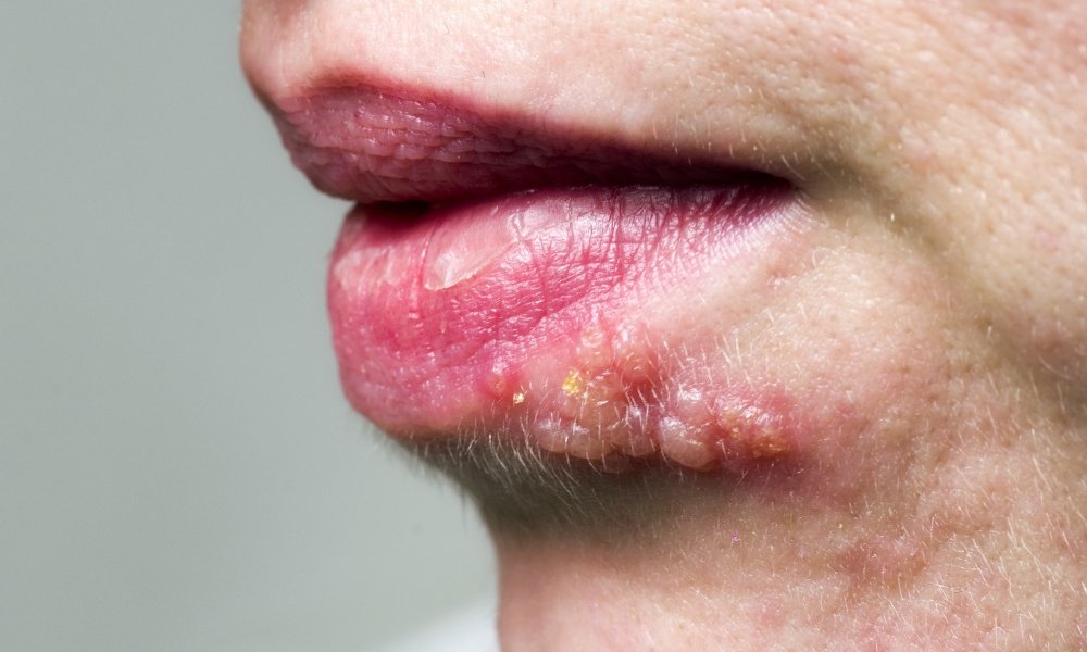 Early stage herpes blister forming on upper lip showing redness and tingling symptoms